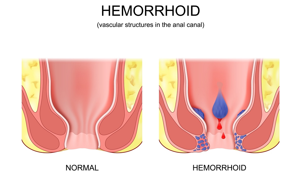 simptome hemoroizi